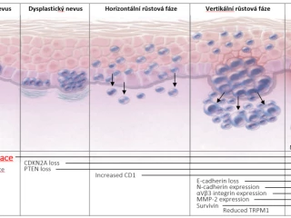 Patogeneze_melanomu
