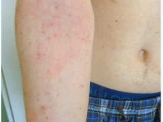 Kazuistika atopické dermatitidy u adolescenta