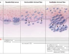 Patogeneze_melanomu