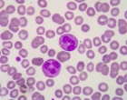 patologie_laborator_nalez_histologie_rakovina_bunky_2