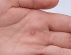 HPV_bradavice_dlan