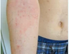 Kazuistika atopické dermatitidy u adolescenta