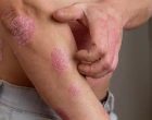 Psoriáza