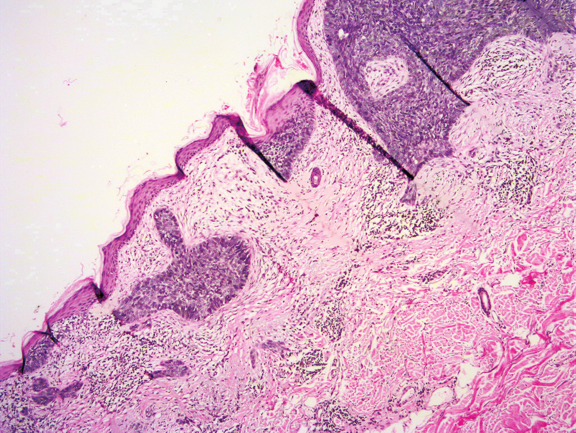 Basal cell carcinoma of the skin with mixed histomorphology a