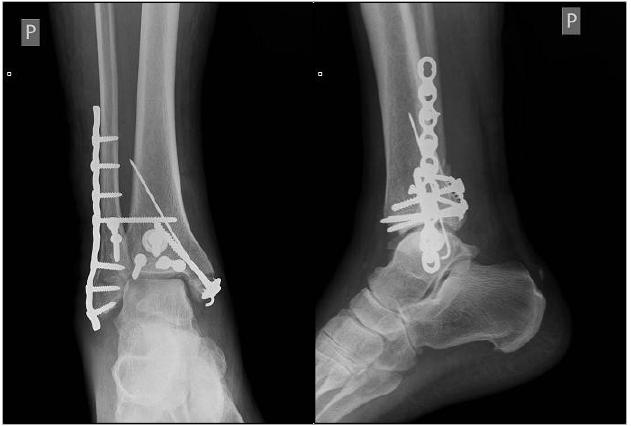 Osteosyntéza zadní hrany tibie – ano či ne? | proLékaře.cz