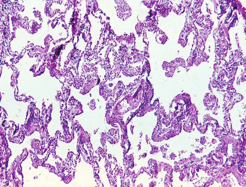 Nespecifickou intersticiální pneumonii charakterizuje uniformní a rovnoměrně rozložené ztluštění alveolárních sept. HE, 120krát