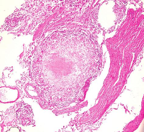 Critical complications of intestinal tuberculosis − a case report ...