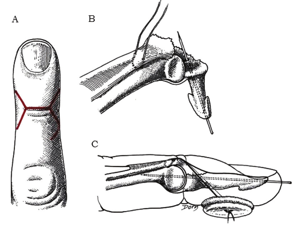 Poranenia extenzorového aparátu v zóne I mallet deformita proLékaře.cz