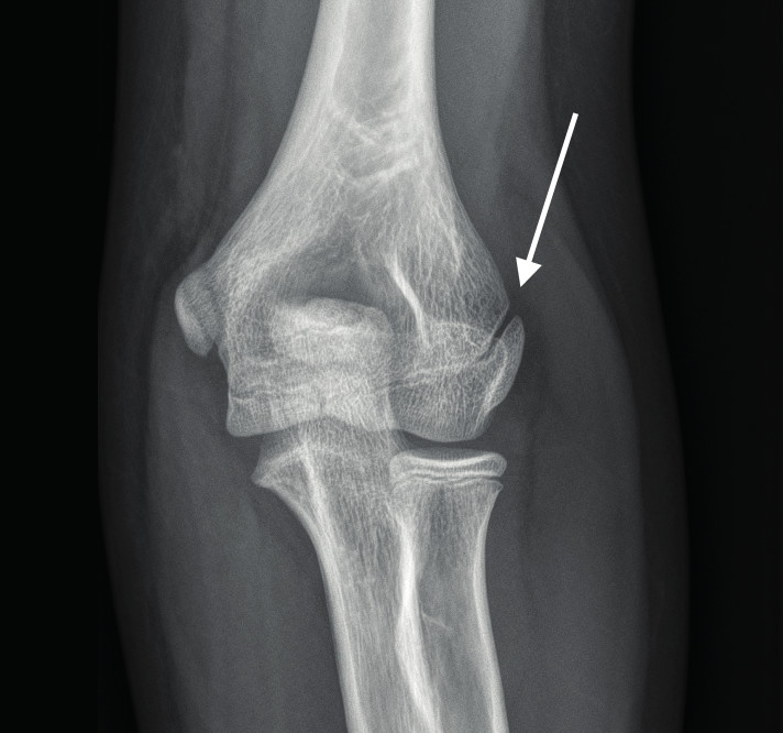 Developmental morphology of the elbow joint in relation to injuries of ...